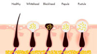 21+ Cara Menghilangkan Jerawat Pasir Secara Alami