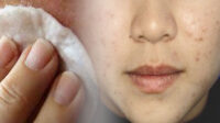 21+ Cara Menghilangkan Jerawat Secara Alami, Mudah dan Cepat
