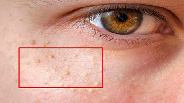 25+ Cara Menghilangkan Bintik di Wajah dengan Bahan Alami