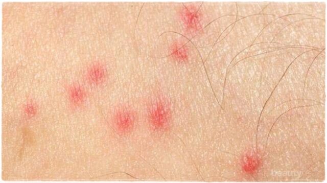 29+ Cara Menghilangkan Bekas Gigitan Nyamuk Secara Alami