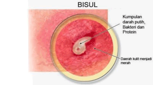 10 Cara Mengobati Bisul Dengan Bahan Alami
