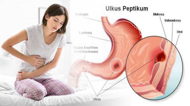 Akupuntur Untuk Mengobati Penyakit Maag